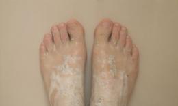 如何使用茶树精油治疗脚指甲真菌感染